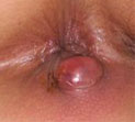 肛周脓肿的症状表现